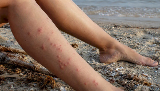 Close-up of itchy sandfly bite clusters on lower legs
