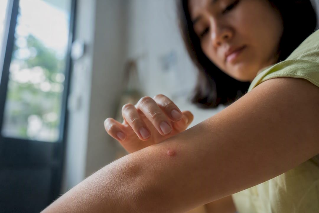 Hand pausing above an itchy mosquito bite